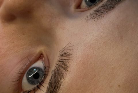 Microneedling
